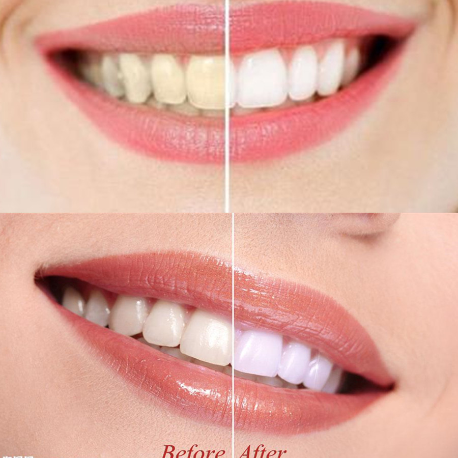 Than Tre Răng Răng Nha Khoa De - đánh giá và giá Teeth Whitening China