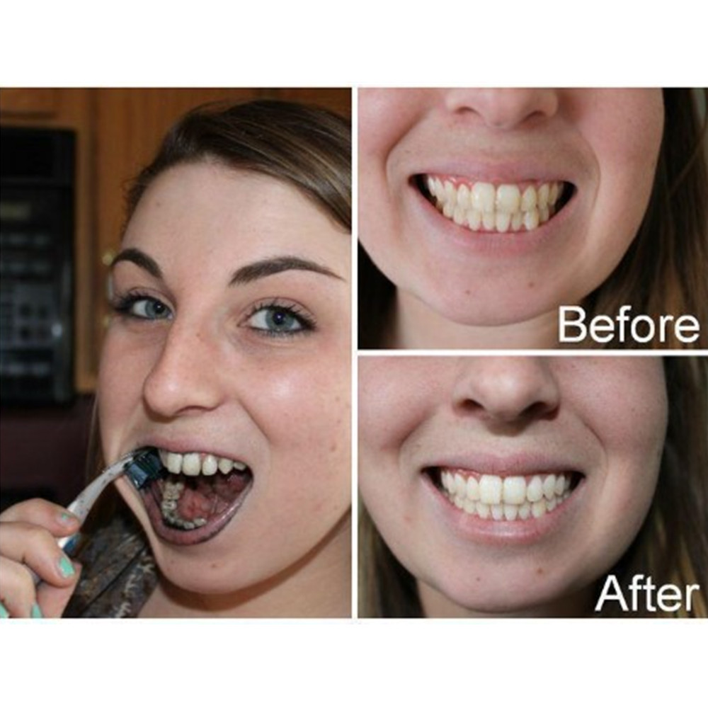 Than Tre Răng Răng Nha Khoa De - đánh giá và giá Teeth Whitening China