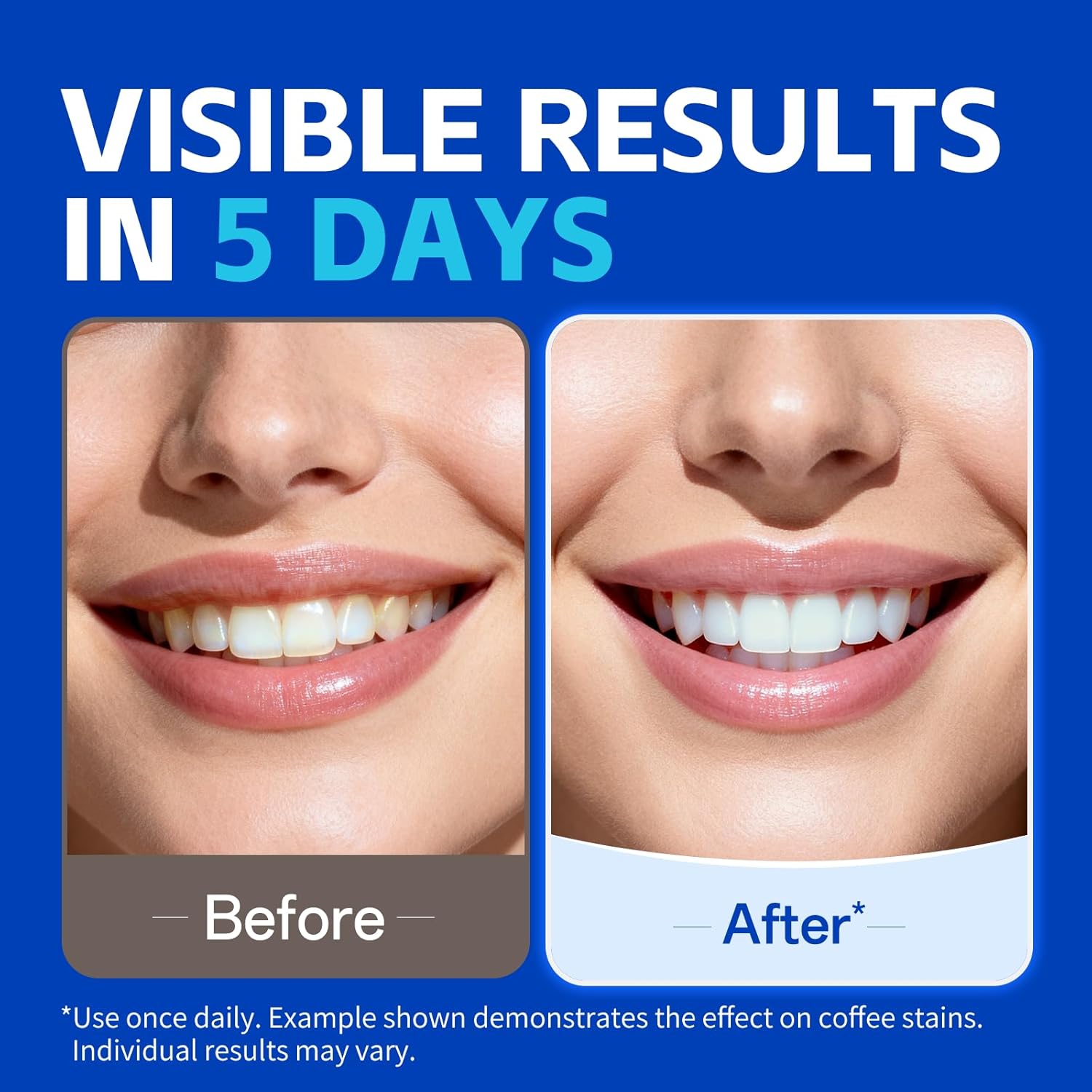 7 pairs Teeth Whitening Strips - đánh giá và giá Teeth Whitening Strips Permanent