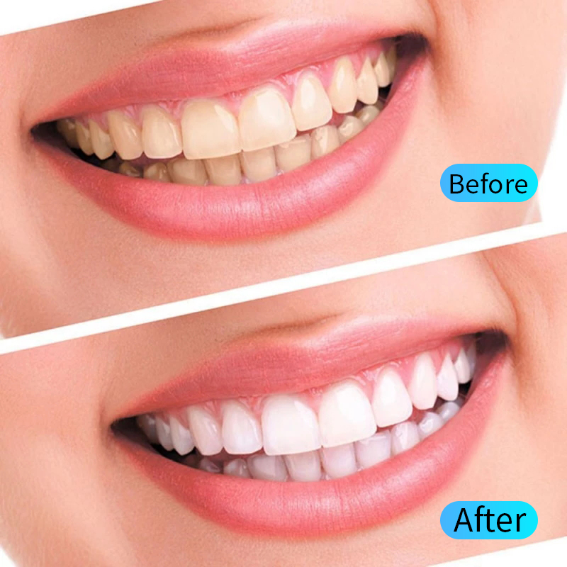 Teeth Whitening Gel Kit Oral H - đánh giá và giá Teeth Whitening Filter