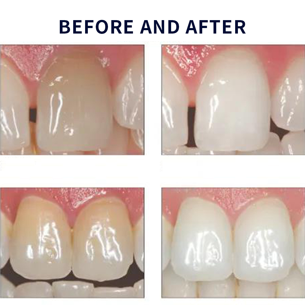 Opalescence Whitening 20% PF 2 - đánh giá và giá Teeth Whitening Hydrogen Peroxide