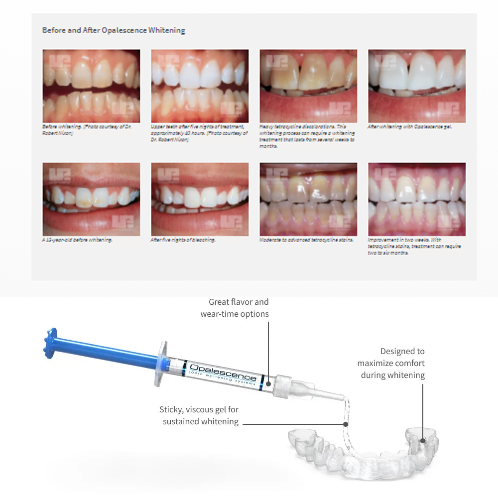 Opalescence Whitening 20% PF 2 - đánh giá và giá Teeth Whitening Hydrogen Peroxide