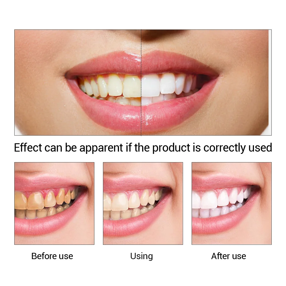 FTEENPLY Làm Trắng Răng Tinh C - đánh giá và giá Teeth Whitening China