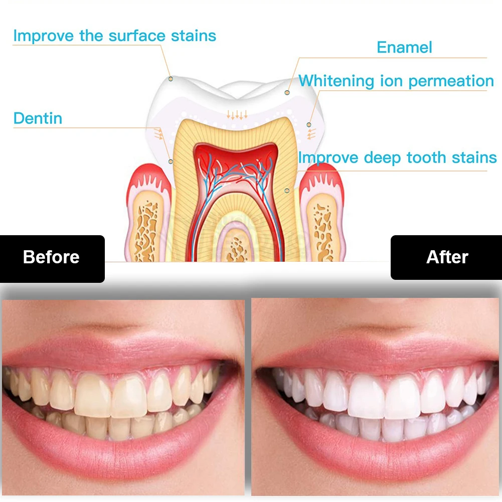 Dental Teeth Whitening Kit Min - đánh giá và giá Teeth Whitening Hydrogen Peroxide