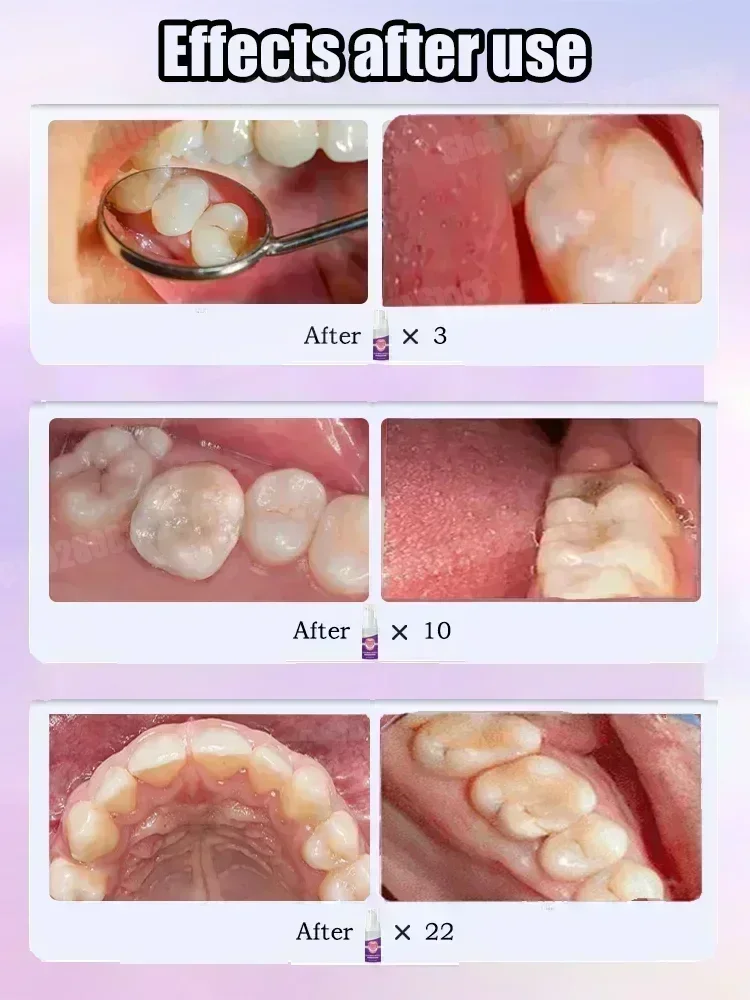 Teeth Cleaning Toothpaste Remo - đánh giá và giá Teeth Whitening Toothpaste